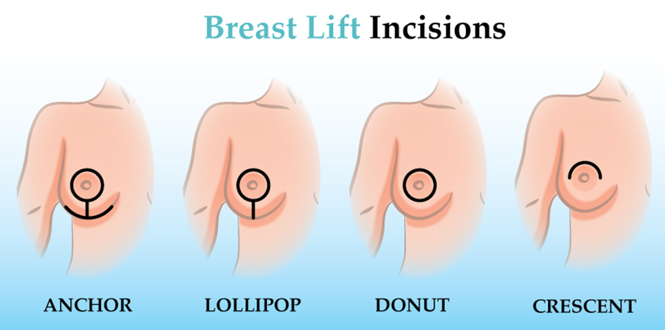 How to tell if you should get a breast lift