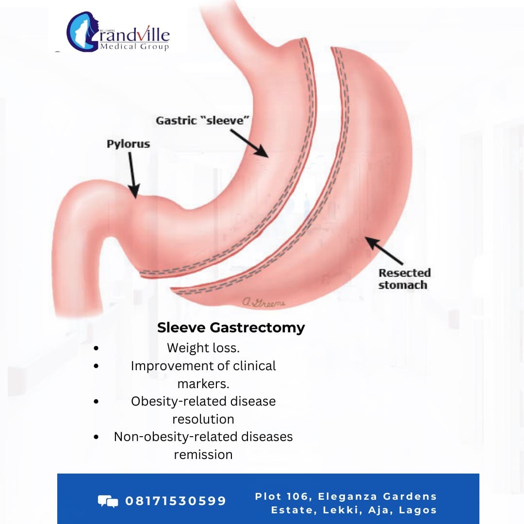 Gastric bypass